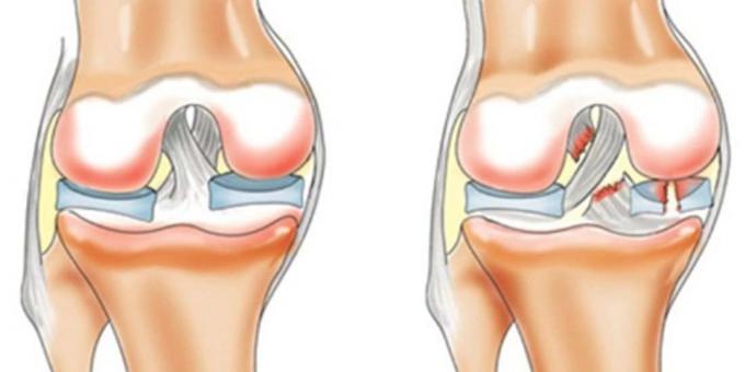 Warum verletzt die Knie: vordere Kreuzbandriss