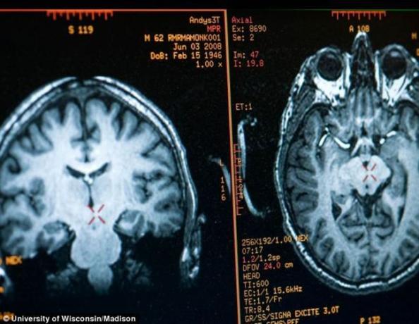 Gehirn Mathieu Ricard Bild von MRI erhalten
