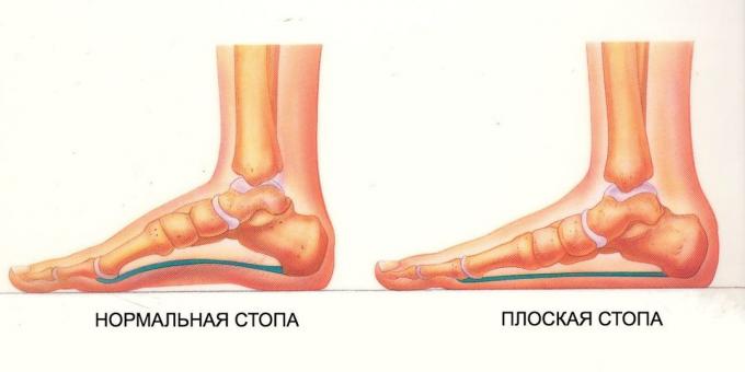 Übungen für die Füße platt: normal und Plattfuß
