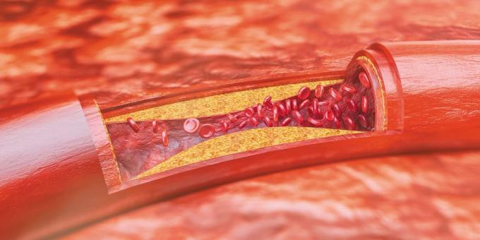 Cholesterin: atherosklerotischen Plaques