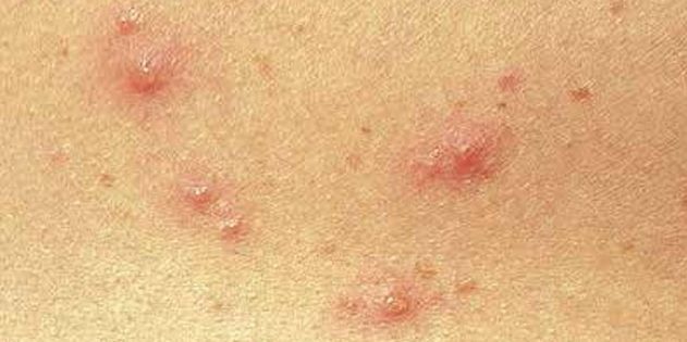 Symptome von Windpocken bei Kindern und Erwachsenen: Oft wird die Haut sofort erscheinen kleine rote Punkte