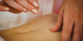 Akupunktur: Was ist mit der Behandlungswissenswert dünnen Nadeln