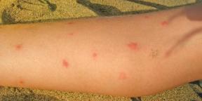 Was tun nach einem Mückenstich, um Komplikationen zu vermeiden?